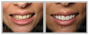 Porcelain Veneers Before and After