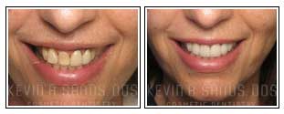 Porcelain Veneers Before and After