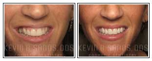 Porcelain Veneers Before and After