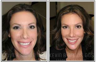 Porcelain Veneers Beverly Hills