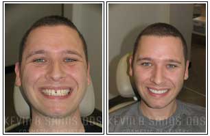 Porcelain Veneers Before and After