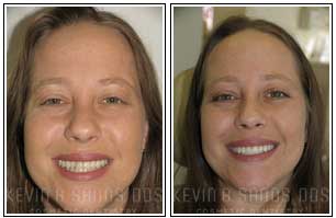 Porcelain Veneers Before and After