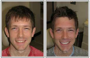 Porcelain Veneers Before and After