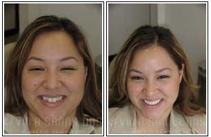 Porcelain Veneers Before and After