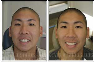 Porcelain Veneers Before and After