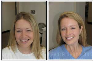 Porcelain Veneers Before and After